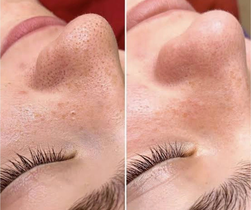 Sugador profissional com 6 ponteiras e 3 níveis de sucção