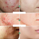 Acne creme facial